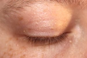 Rimedi naturali contro i grani di miglio